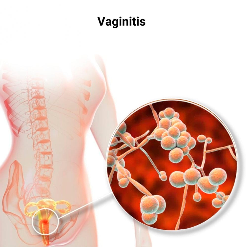Vaginitis