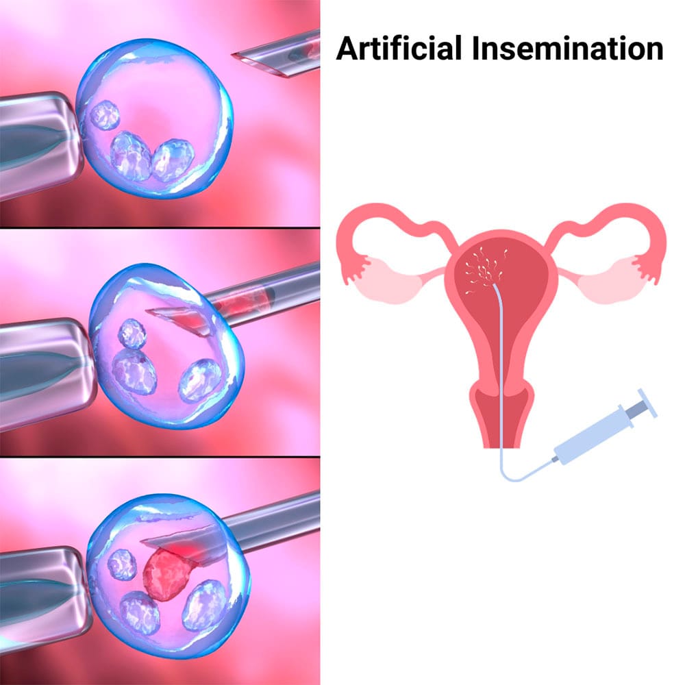 Artificial Insemination in Midtown Manhattan