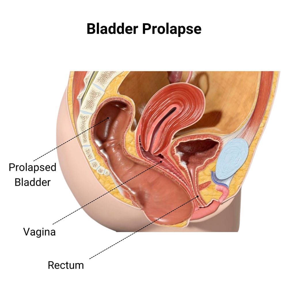 Bladder Prolapse Treatment in Midtown, Manhattan