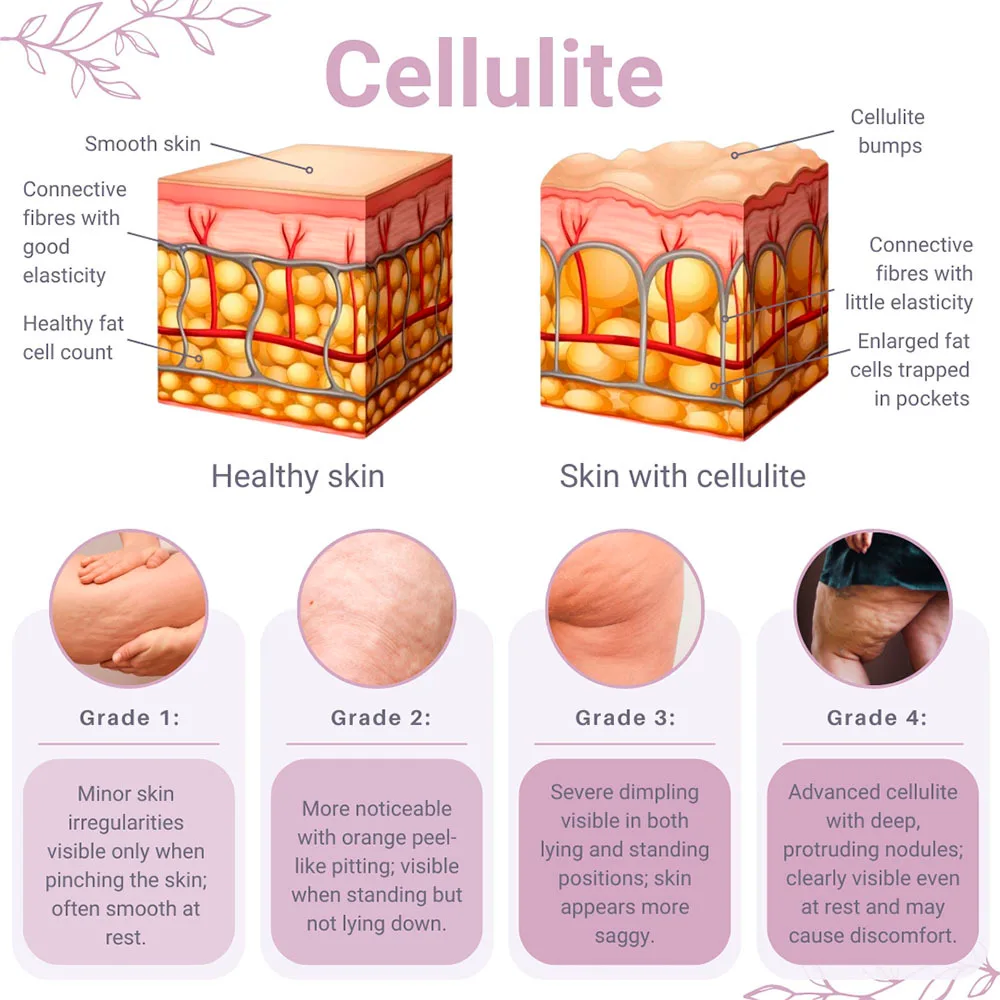 Cellulite Diagram