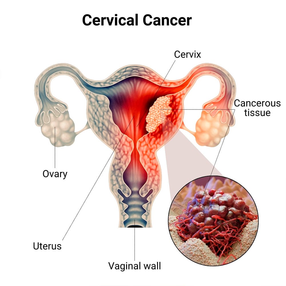 Cervical Cancer