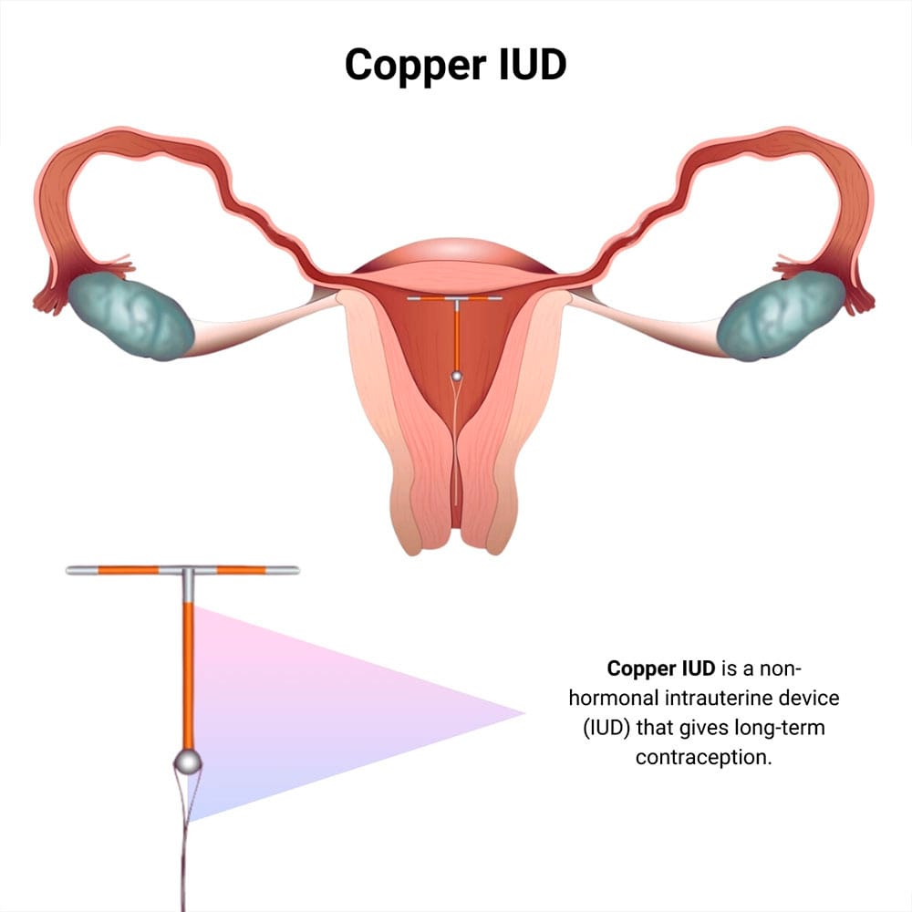 Copper IUD in Midtown Manhattan