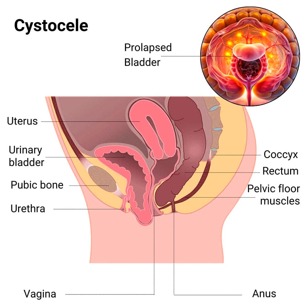 Cystocele Treatment in Midtown Manhattan