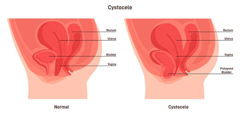 Cystocele