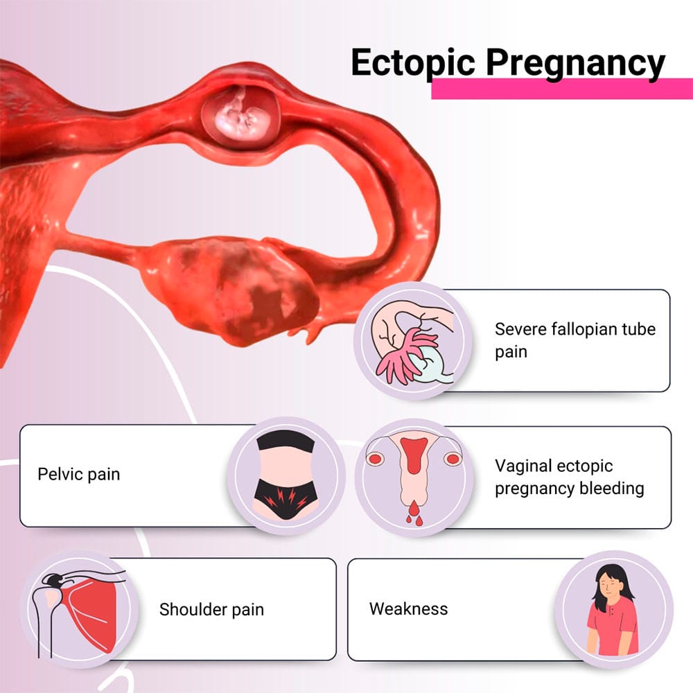 Ectopic Pregnancy Midtown, Manhattan