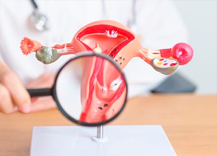 Endometrial polyps (Uterine Polyps)