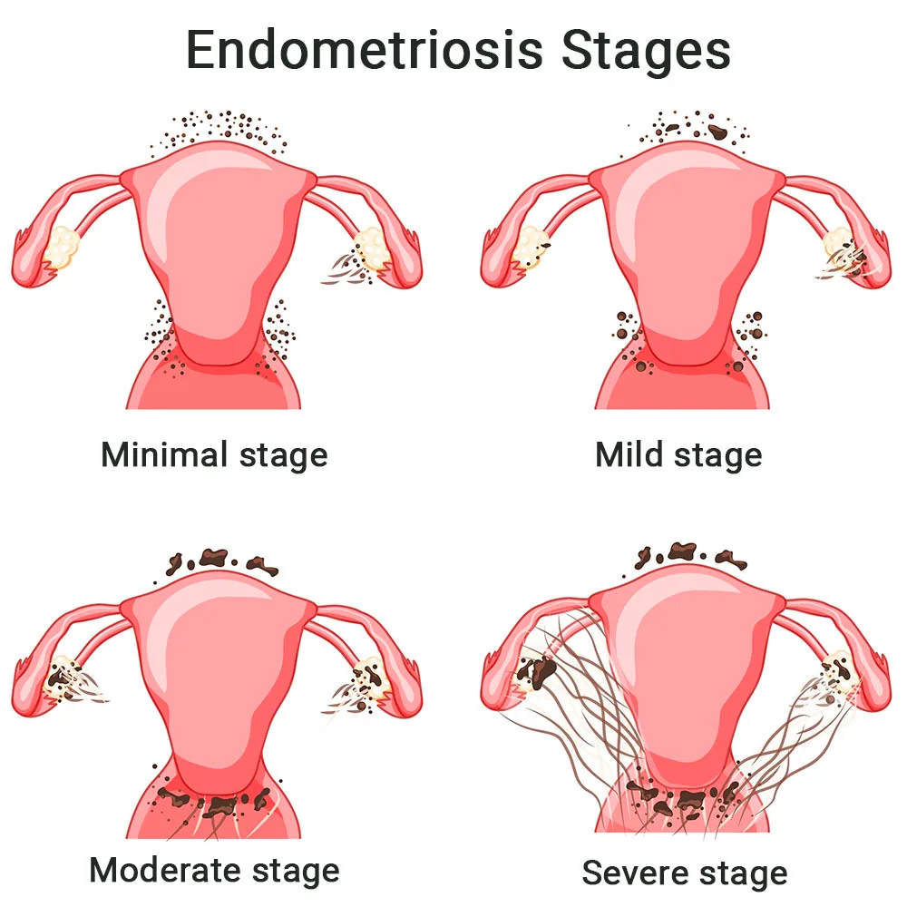 Endometriosis Stages