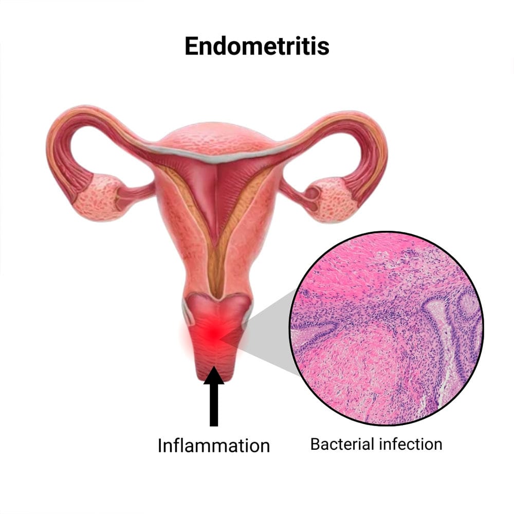 Endometritis Treatment in Midtown, Manhattan