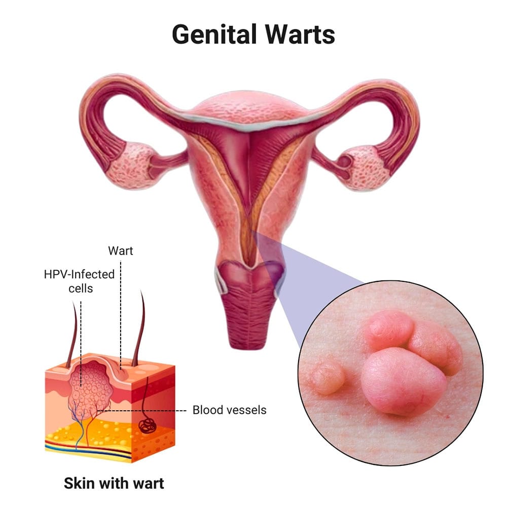 Genital Warts Treatment in Midtown Manhattan