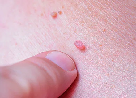 Human Papillomavirus (HPV)