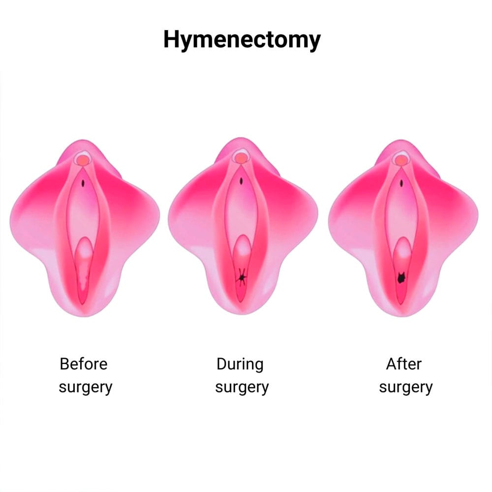 hymenal 