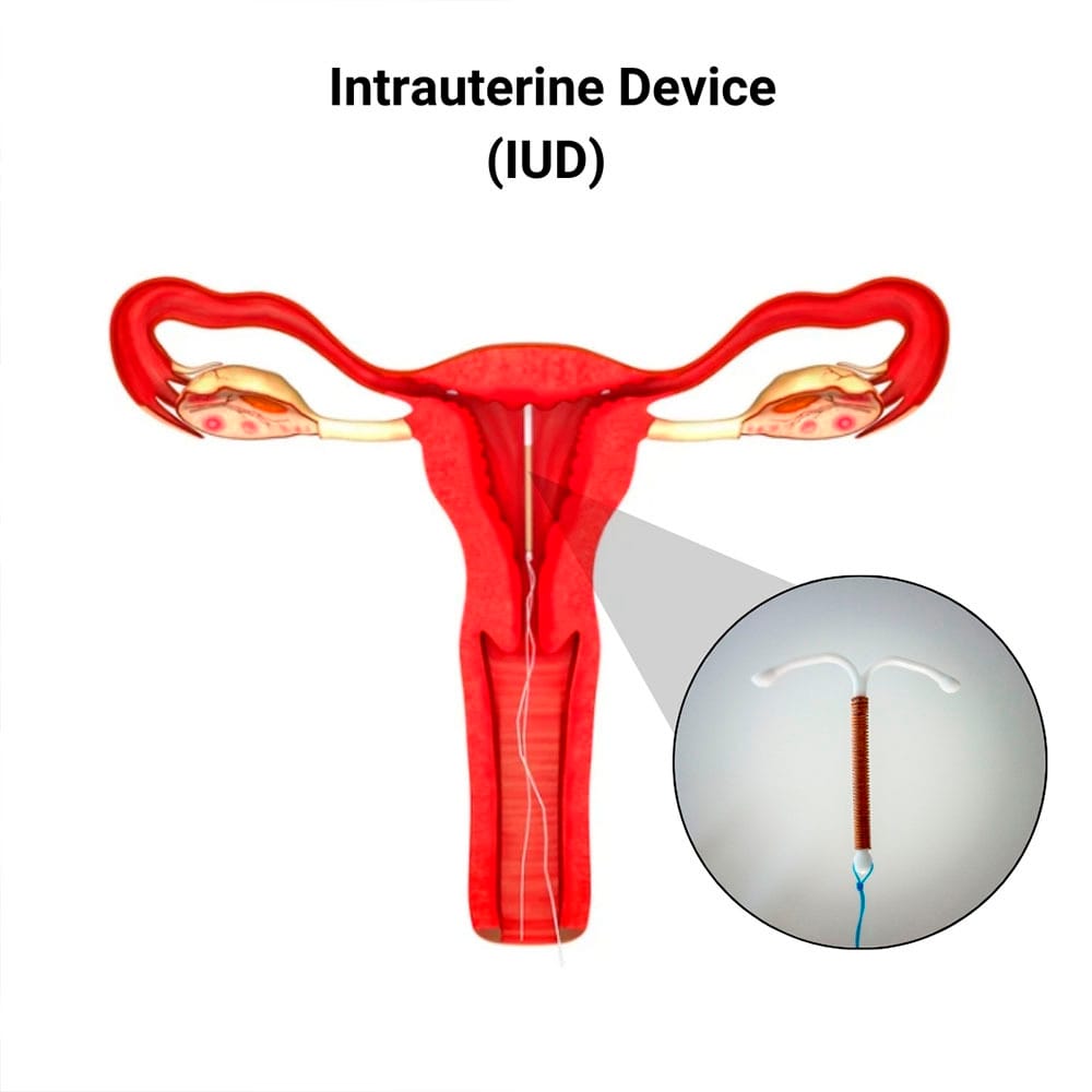 IUD in Midtown Manhattan