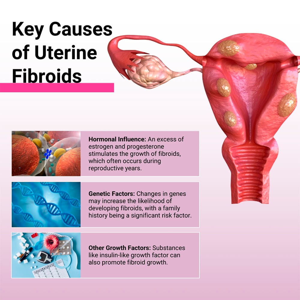 Key Causes of Uterine Fibroids