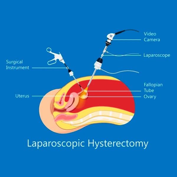 Laparoscopic Hysterectomy