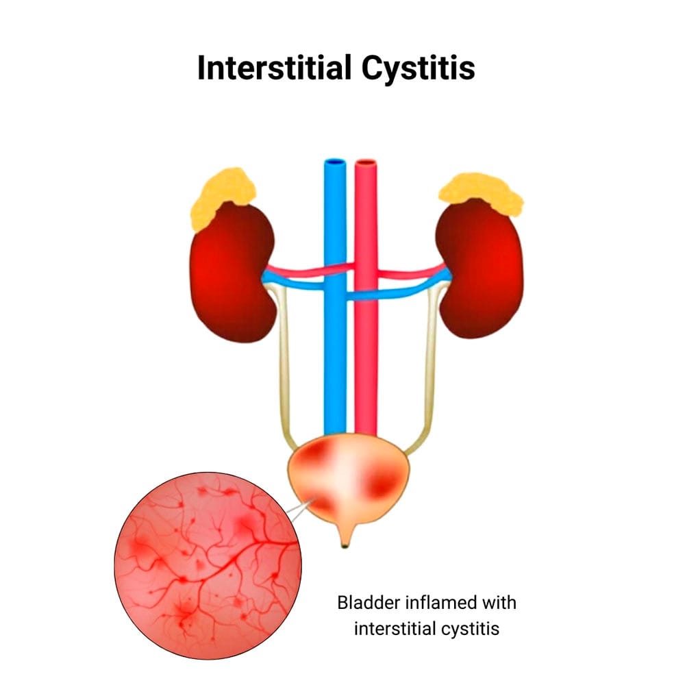 Interstitial Cystitis Treatment in Midtown Manhattan