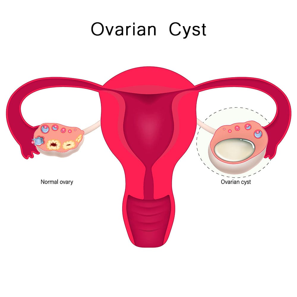 Ovarian Cyst