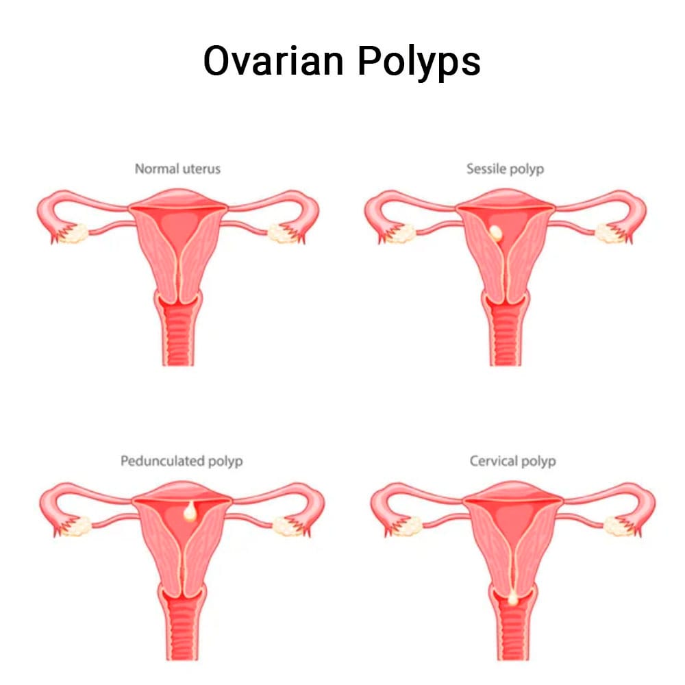Ovarian Polyps Treatment in Midtown Manhattan