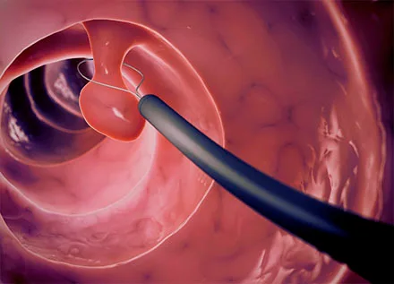 Ovarian polyps