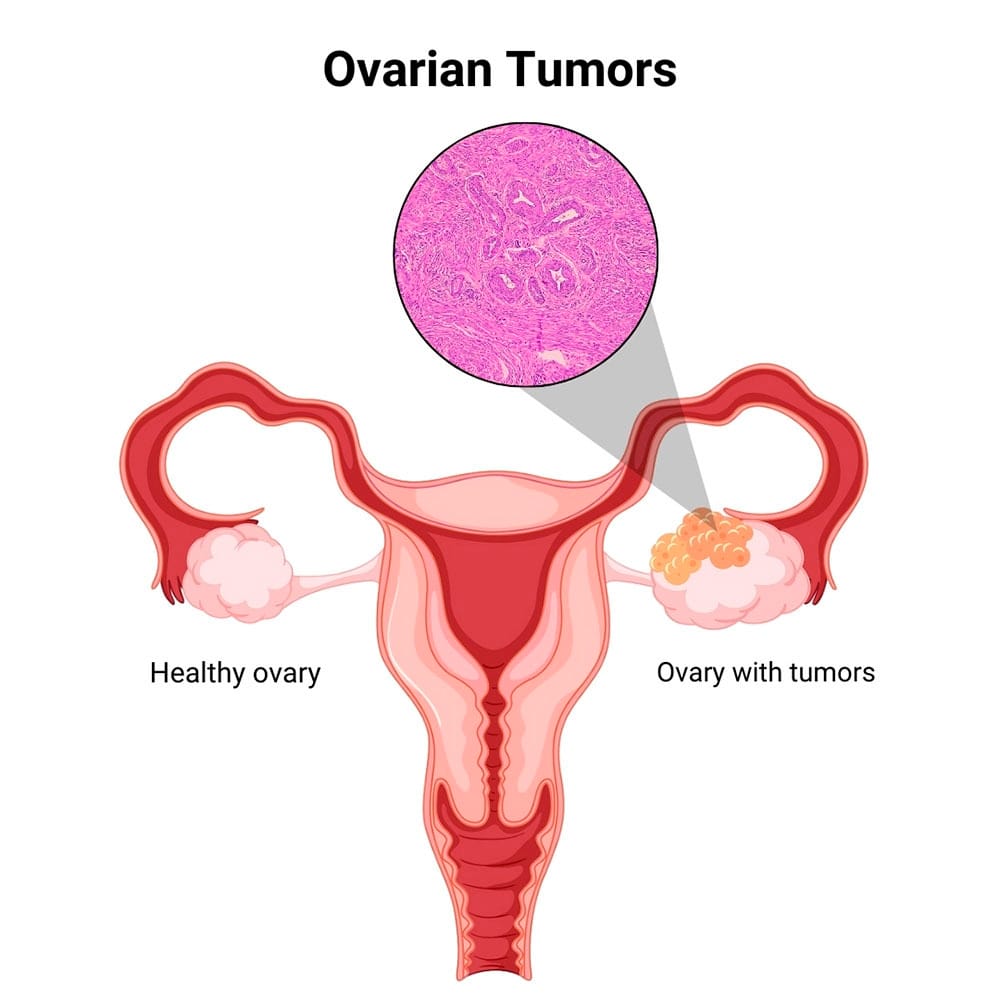 Ovarian Tumors Treatment in Midtown, Manhattan