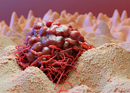 Ovarian tumors