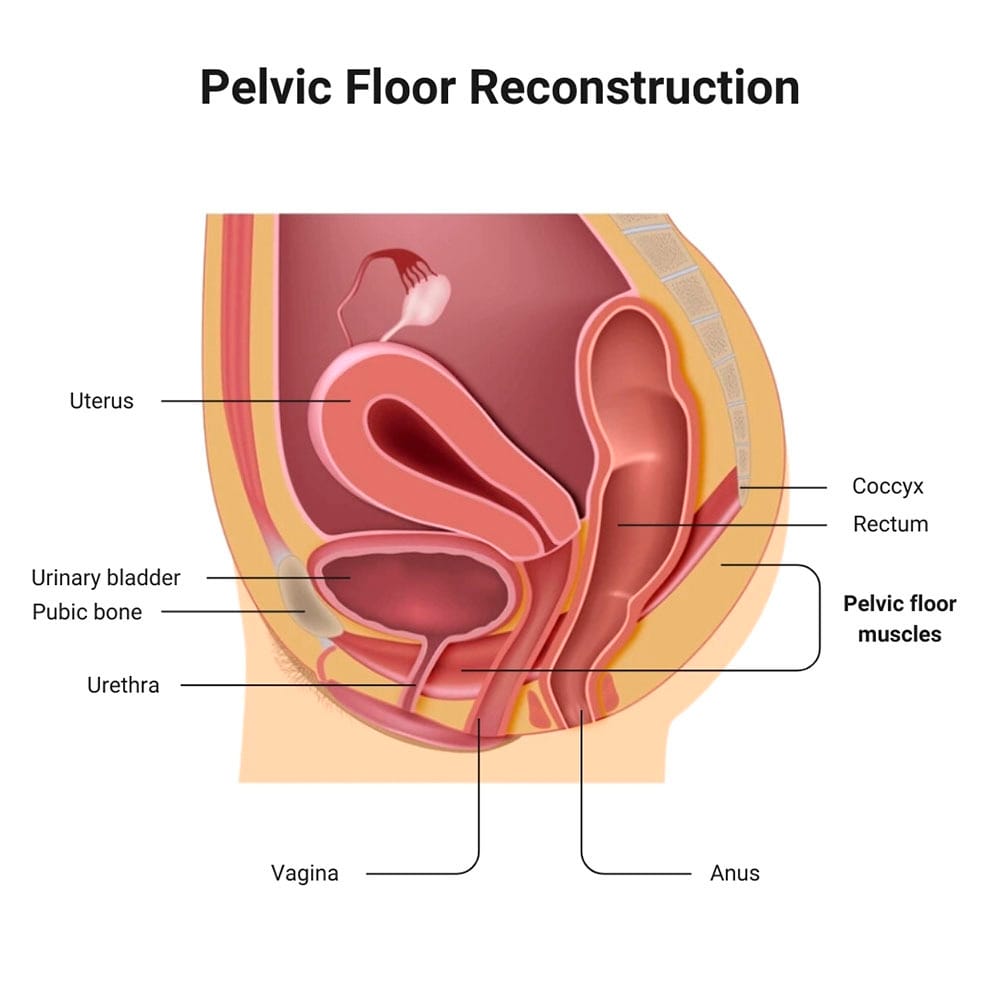 Pelvic Floor Reconstruction in Midtown Manhattan