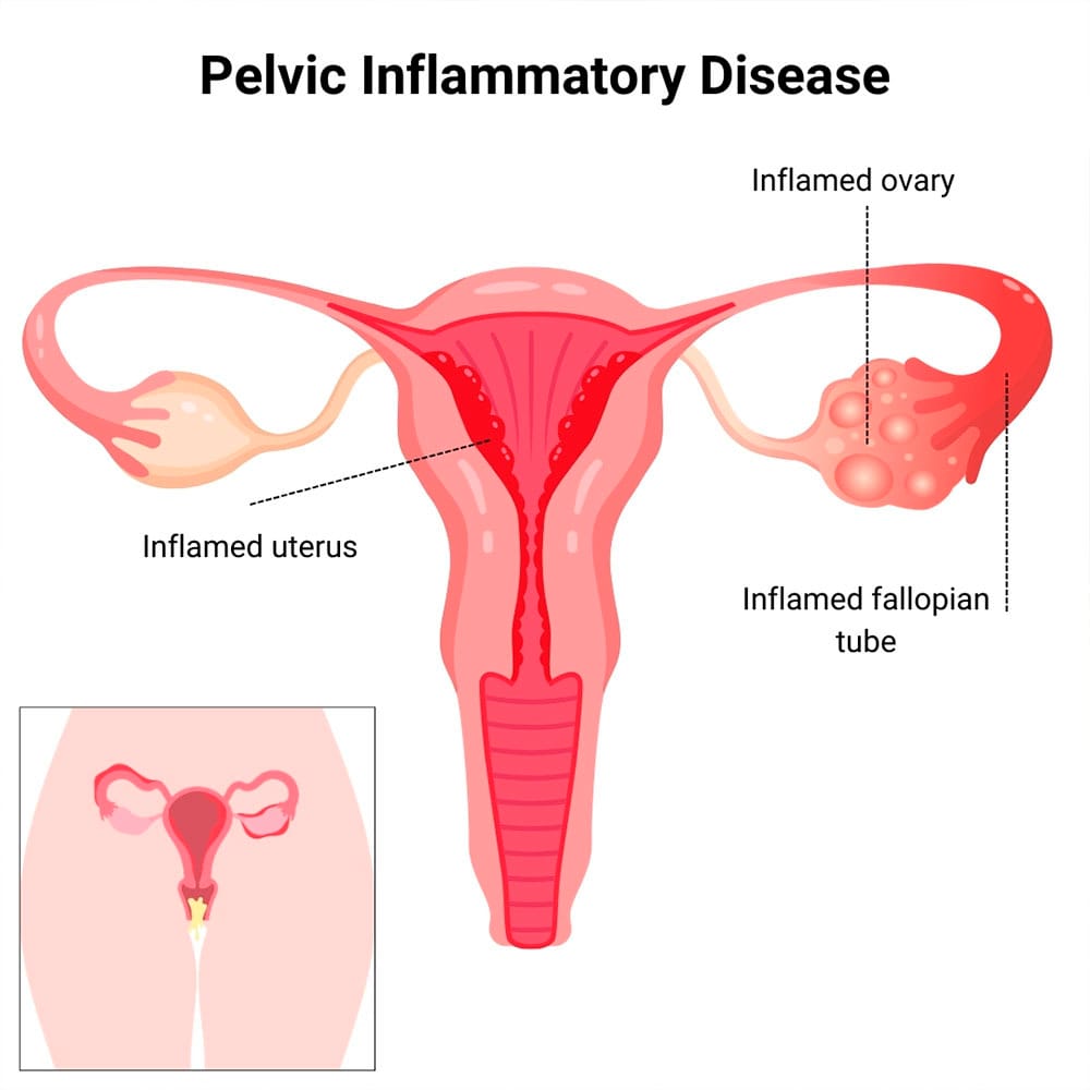 Pelvic Inflammatory Disease