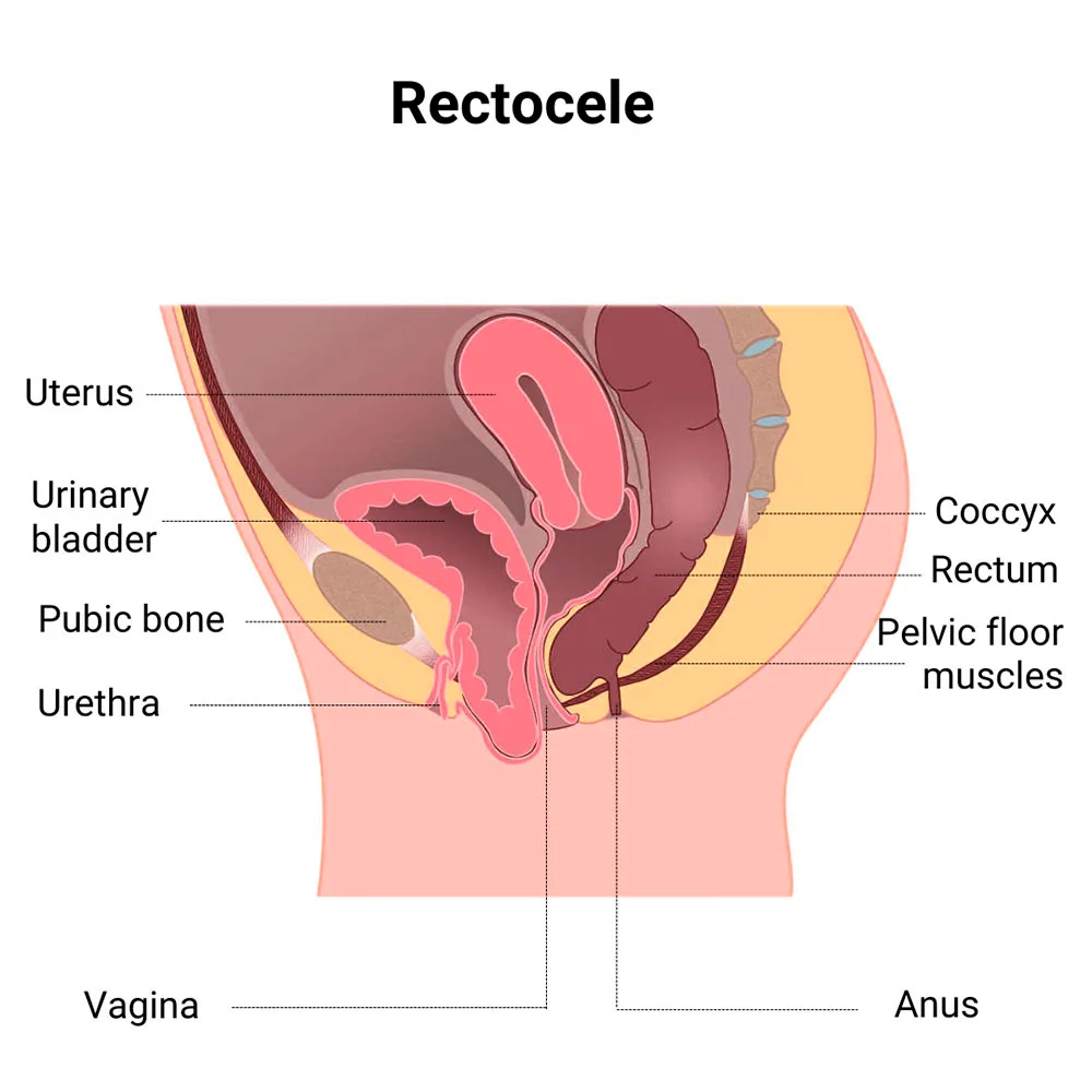 Rectocele Surgery in Midtown, NYC \u0026 Rego Park, Queens | Posterior Prolapse  Treatment in New York, image size:1000x1000