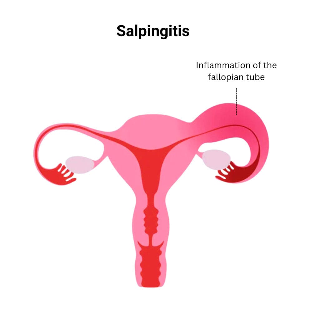 Salpingitis Treatment in Midtown, Manhattan