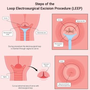LEEP Procedure Midtown, NYC & Rego Park, Queens | Loop Electrosurgical ...