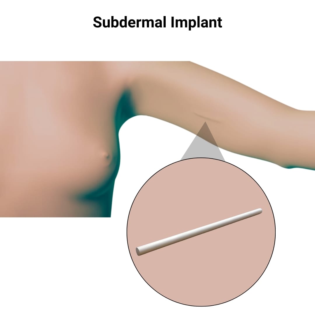 Subdermal Implant
