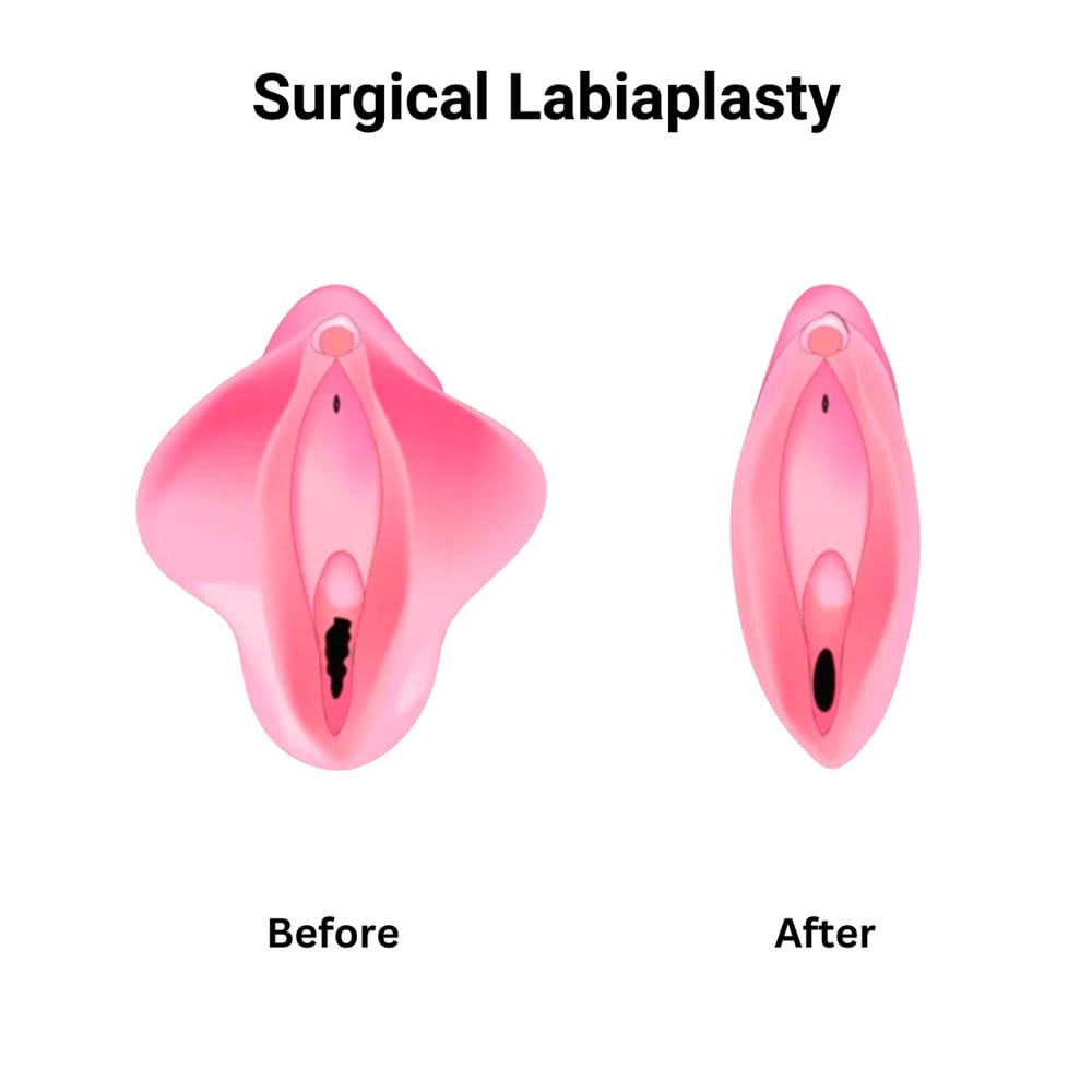 Tempsure Revival Surgical Labiaplasty Midtown, Manhattan