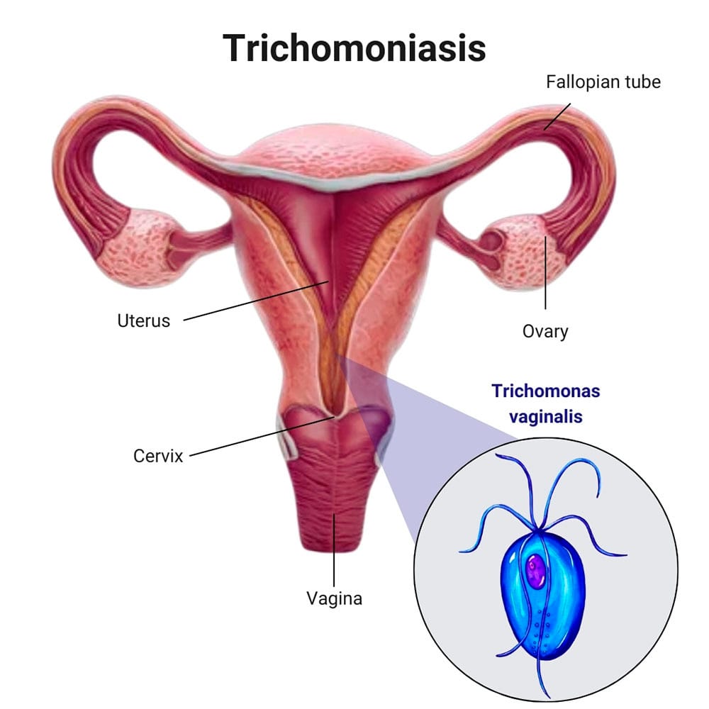 Trichomoniasis Treatment in Midtown, Manhattan