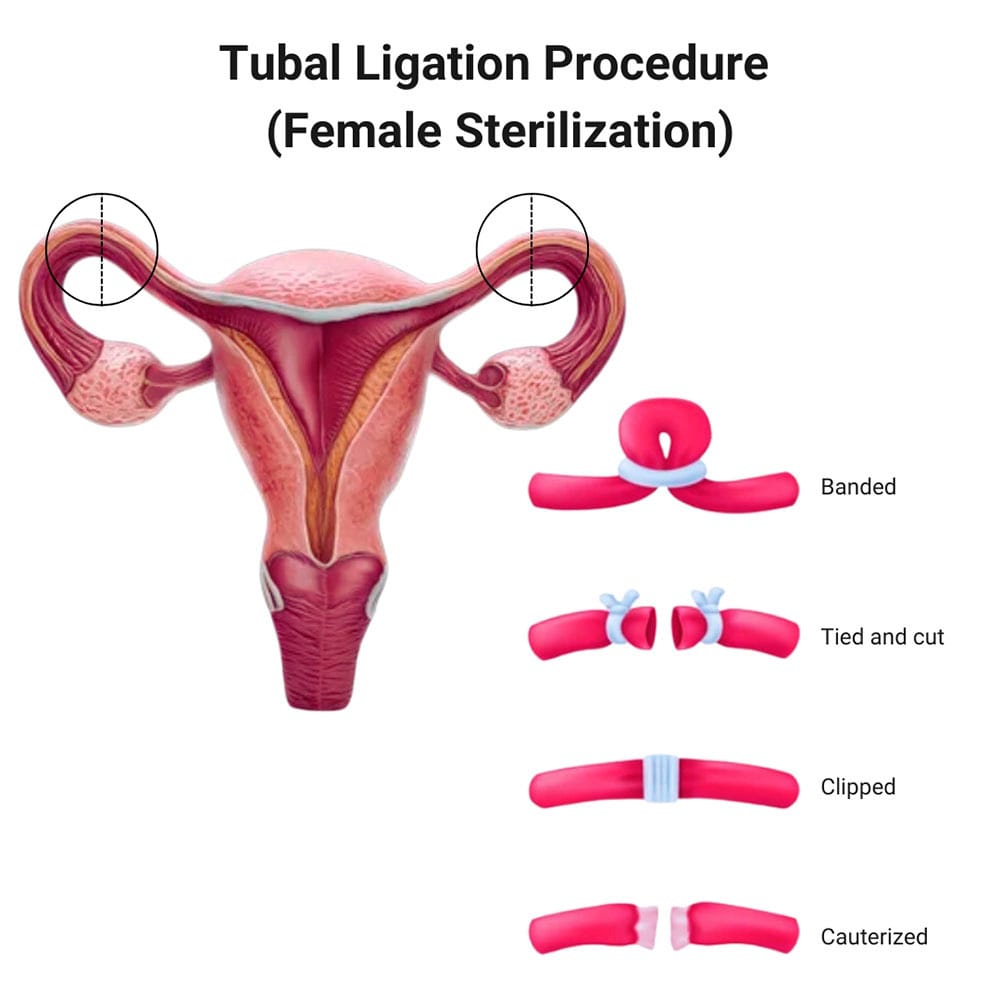 Tubal Ligation Procedure in Midtown Manhattan