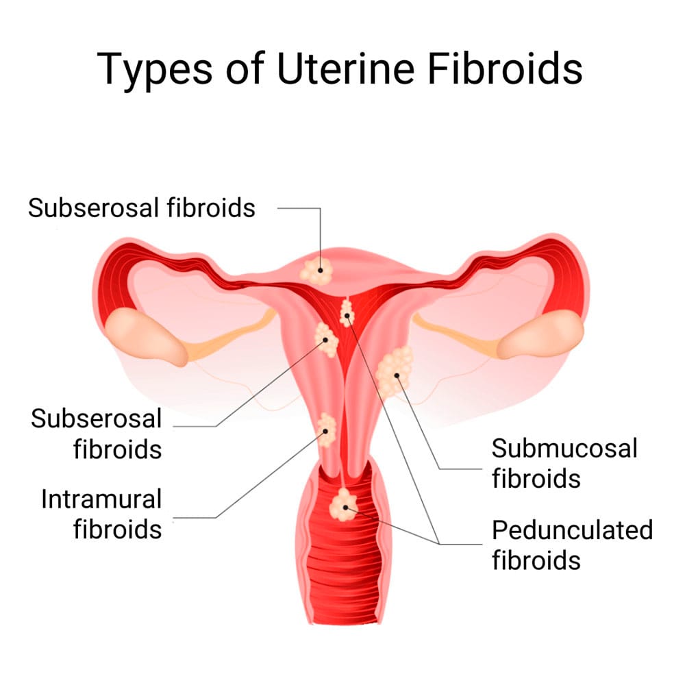 Types of Uterine Fibroids