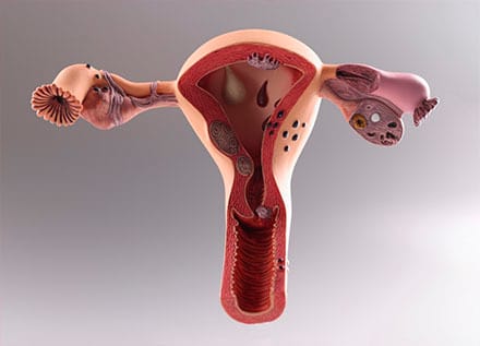 Uterine fibroids