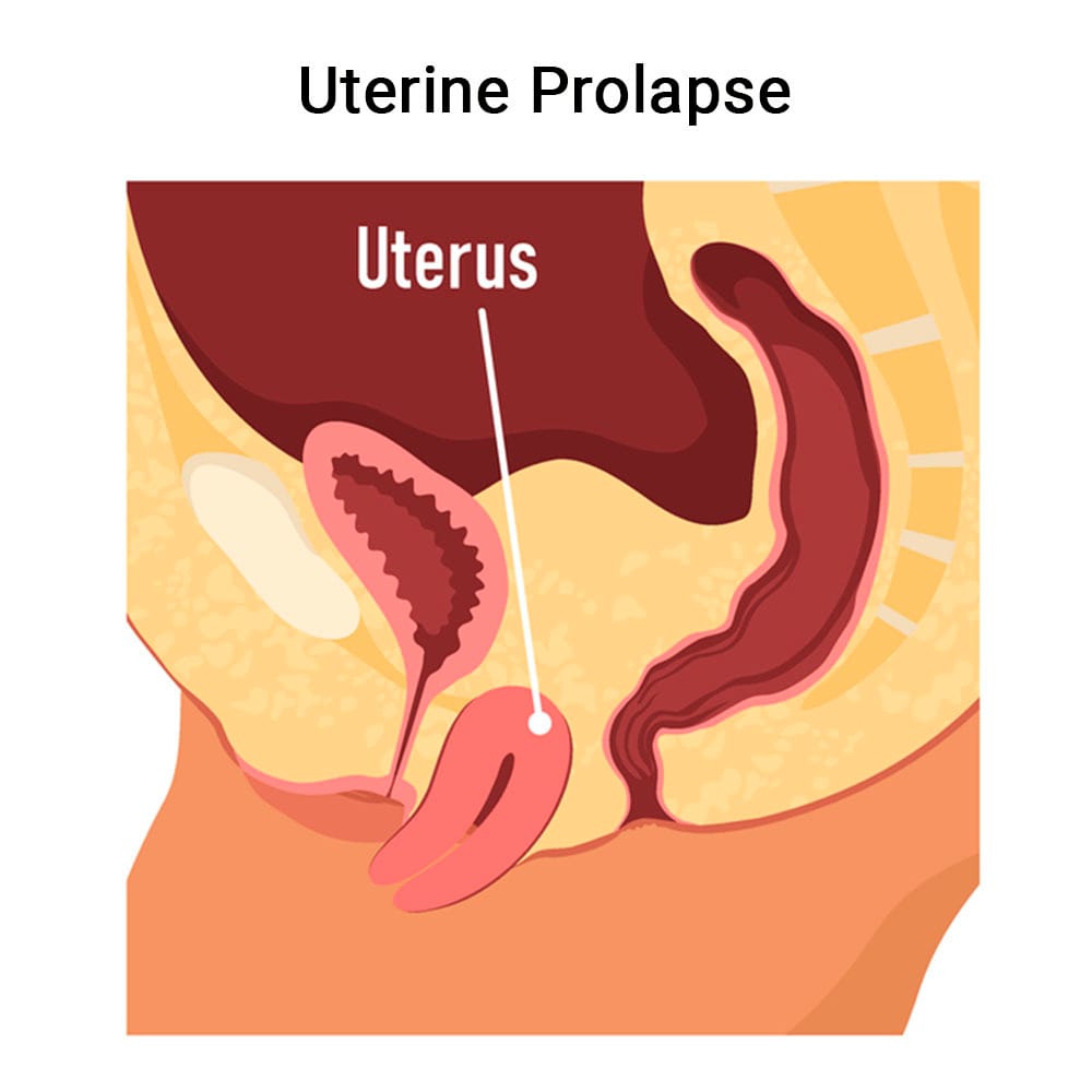 Uterine Prolapse Treatment in Midtown Manhattan