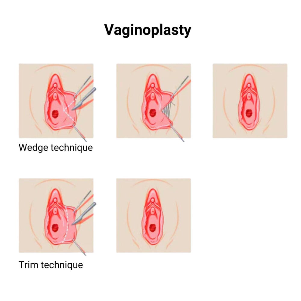 Vaginoplasty in Midtown, Manhattan