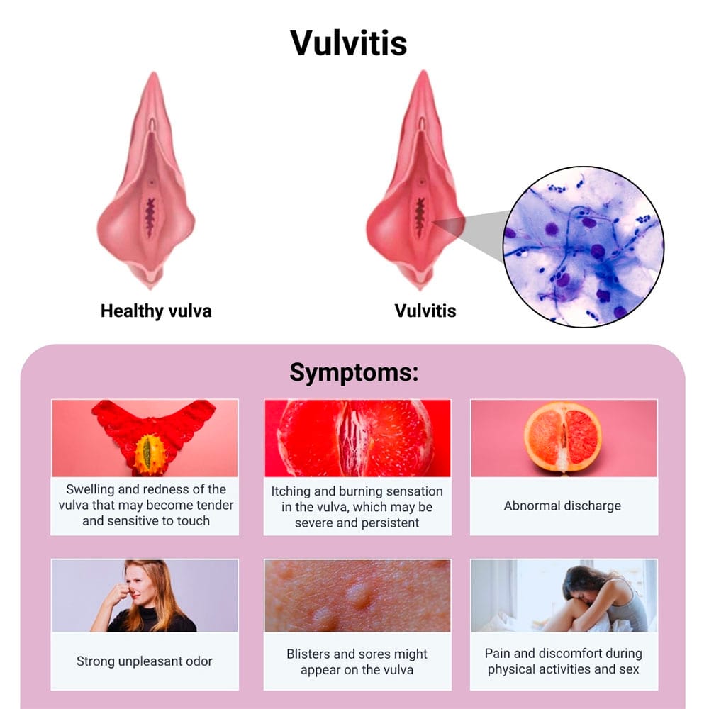 Vulvitis Treatment in Midtown Manhattan