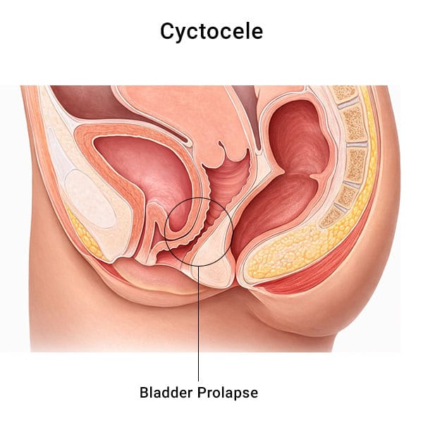Bladder Prolapse Treatment in Midtown, Manhattan