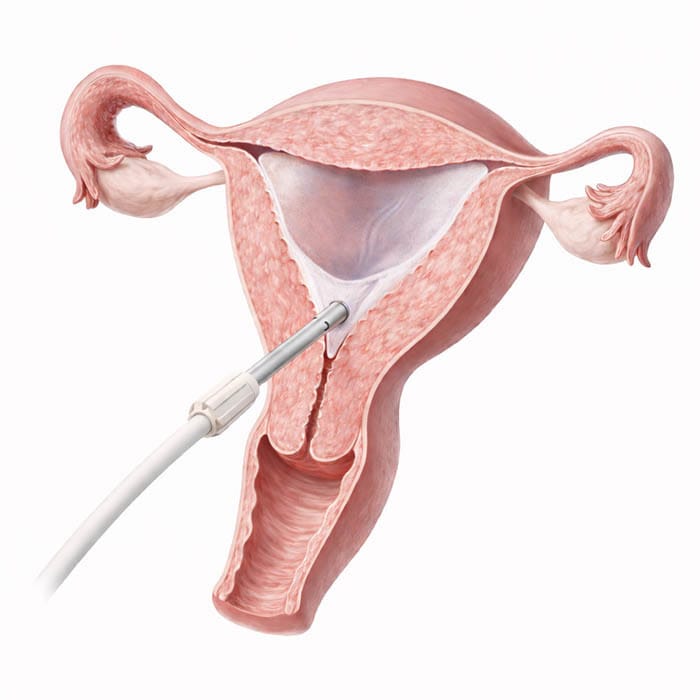 Cerene cryotherapy device performing endometrial ablation inside uterus cross section showing treatment of endometrial lining for heavy menstrual bleeding Cohen Medical Practice